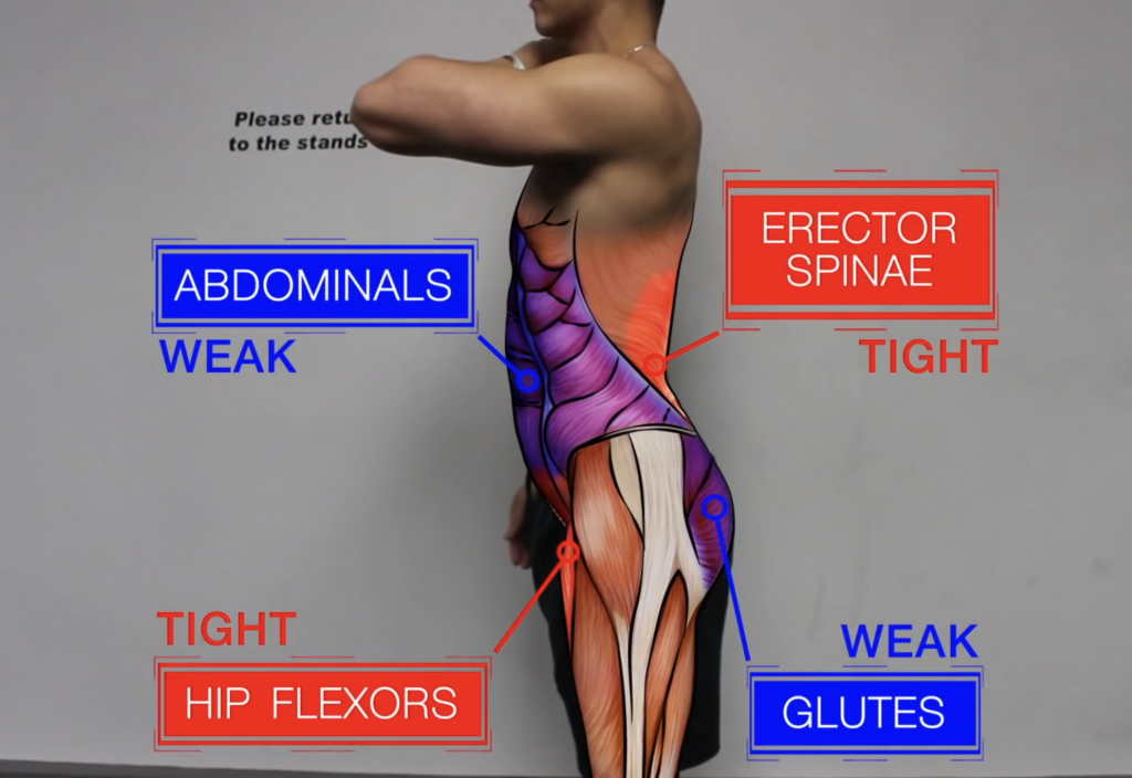 Lower Crossed Syndrome & How To Rectify It